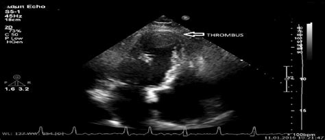 lv thrombus noac|example of laminar thrombus.